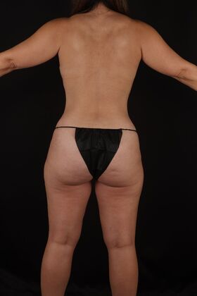 Tummy Tuck: Case 87 - After