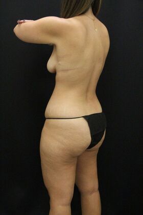 Tummy Tuck: Case 87 - Before
