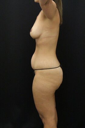 Tummy Tuck: Case 87 - Before
