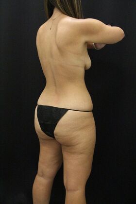 Tummy Tuck: Case 87 - Before