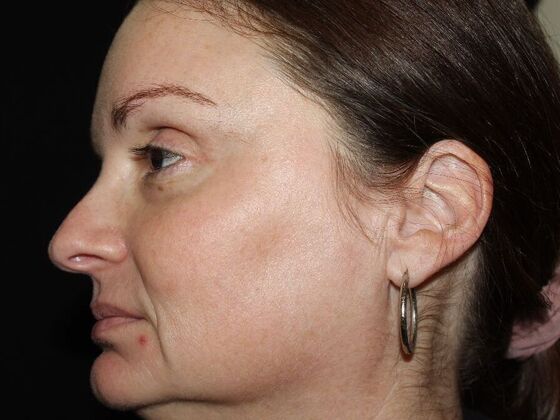 Skin Treatments: Case 19 - After