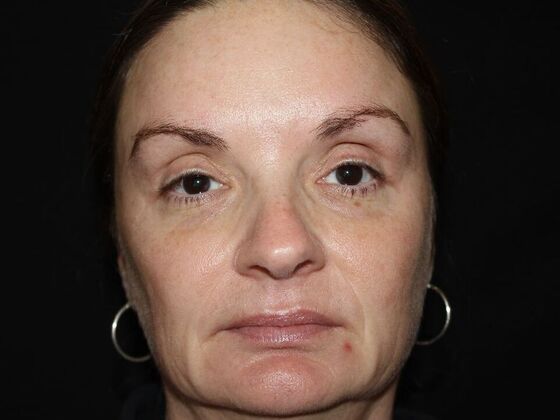 Skin Treatments Case 19 - After