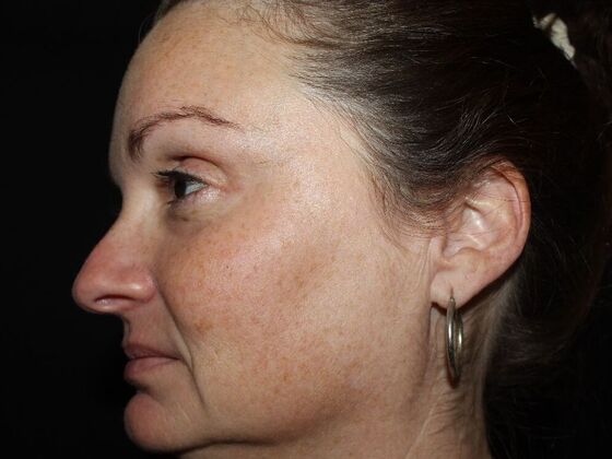 Skin Treatments: Case 19 - Before
