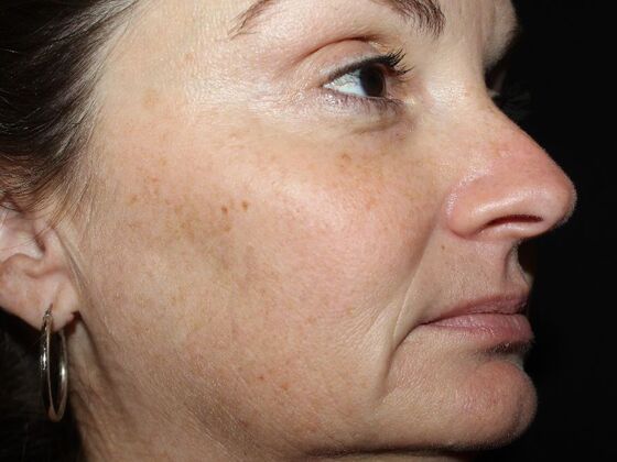 Skin Treatments: Case 19 - Before