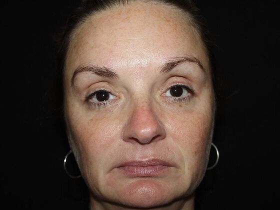 Skin Treatments Case 19 - Before