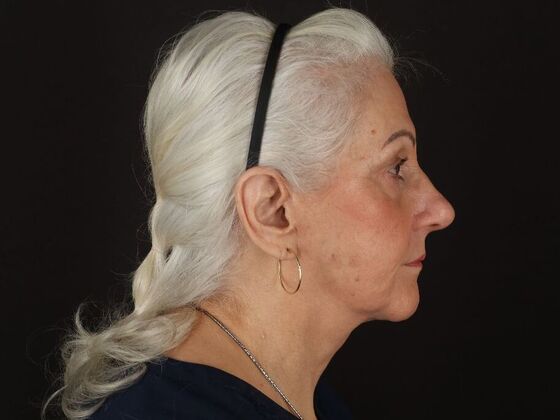 Face & Neck Lifts Case 5 - After