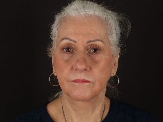 Face & Neck Lifts: Case 5 - After
