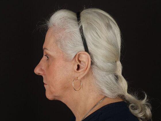 Face & Neck Lifts: Case 5 - After