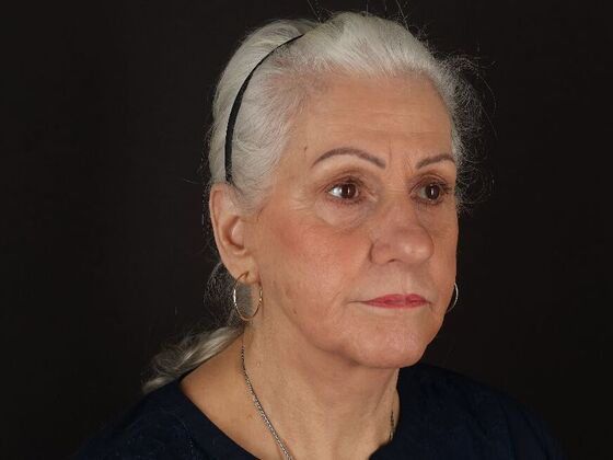 Face & Neck Lifts: Case 5 - After