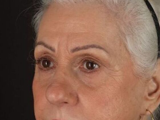 Brow Lift Case 1 - After