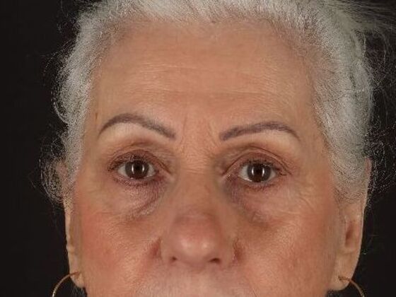 Brow Lift: Case 1 - After