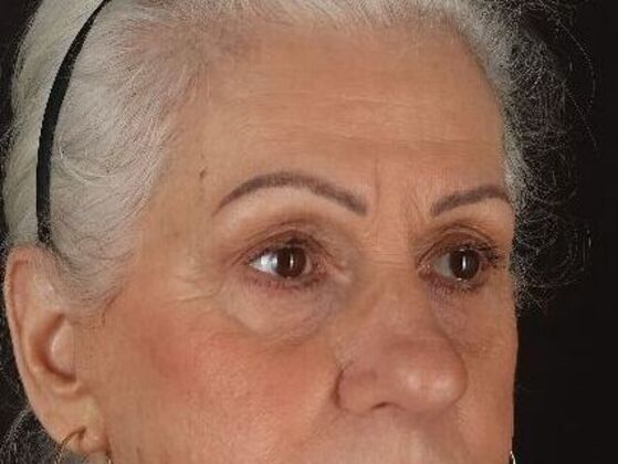 Brow Lift: Case 1 - After