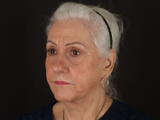 Non-Surgical: Case 1 - After