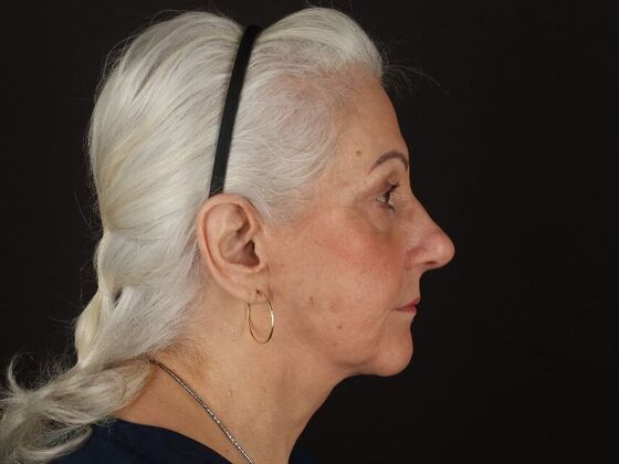 Non-Surgical: Case 1 - After