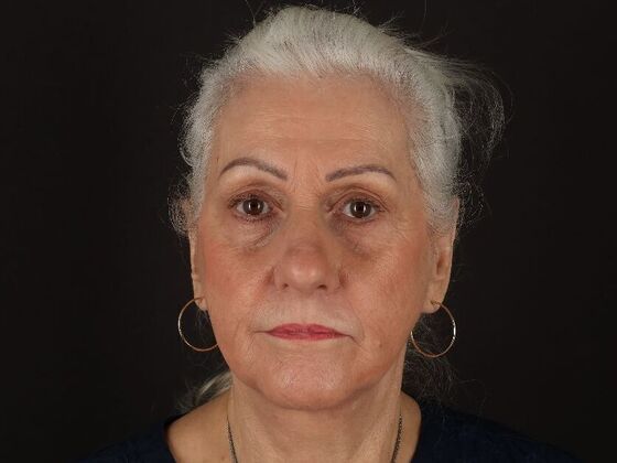 Non-Surgical Case 1 - After