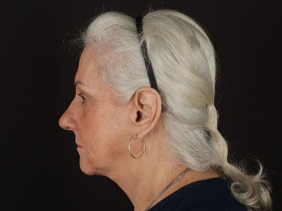 Non-Surgical: Case 1 - After