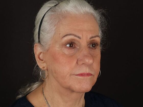 Non-Surgical: Case 1 - After