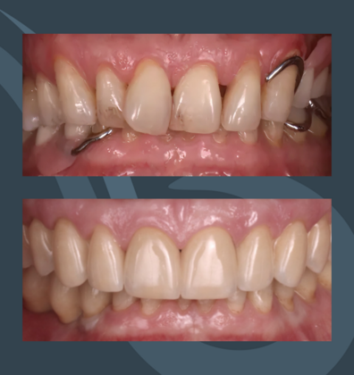 All-on-X Slider Cases