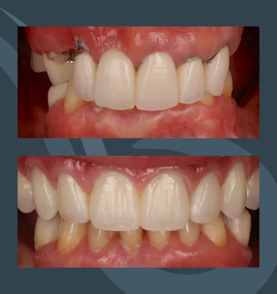 All-on-X Slider Case 2