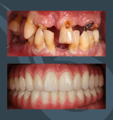 All-on-X Slider Case 4