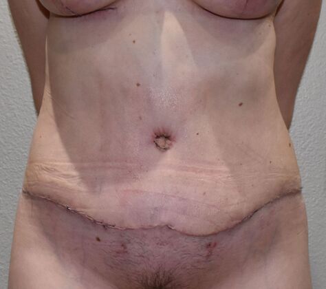 Tummy Tuck (Abdominoplasty): Case 19 - After