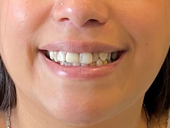 All on 4 (Full Arch Implant Cases) Case 22 - Before