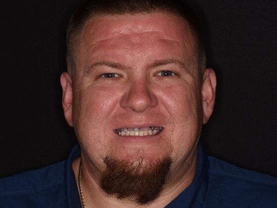 All on 4 (Full Arch Implant Cases) Case 23 - Before