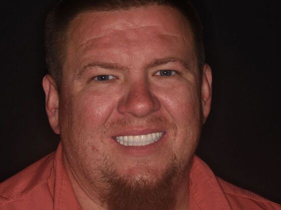 All on 4 (Full Arch Implant Cases) Case 23 - After