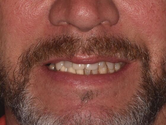 All on 4 (Full Arch Implant Cases) Case 24 - Before