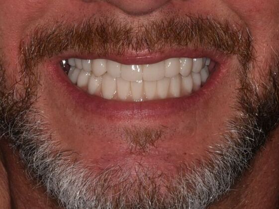 All on 4 (Full Arch Implant Cases) Case 24 - After