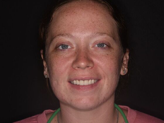 Cosmetic Dentistry Case 3 - After