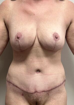 Massive Weight Loss : Case 207 - After