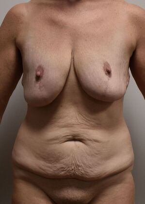 Massive Weight Loss : Case 207 - Before