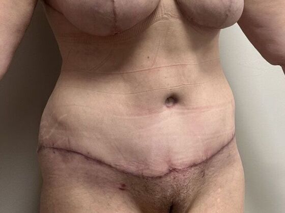 Tummy Tuck (Abdominoplasty): Case 582 - After