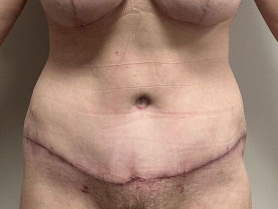 Tummy Tuck (Abdominoplasty): Case 582 - After