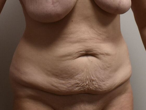 Tummy Tuck (Abdominoplasty): Case 582 - Before