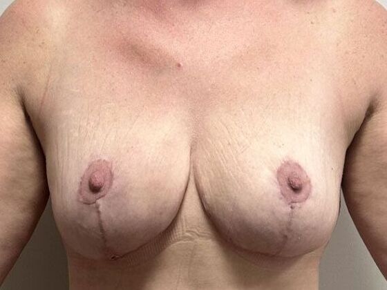 Breast Lift (Mastopexy) Case 263 - After
