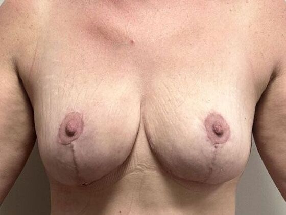 Breast Revision: Case 333 - After