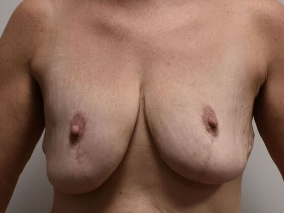 Breast Revision: Case 333 - Before