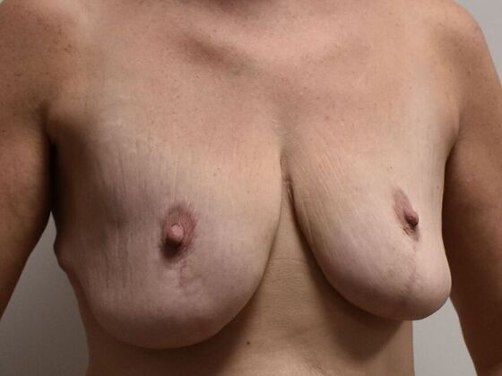 Breast Revision: Case 333 - Before