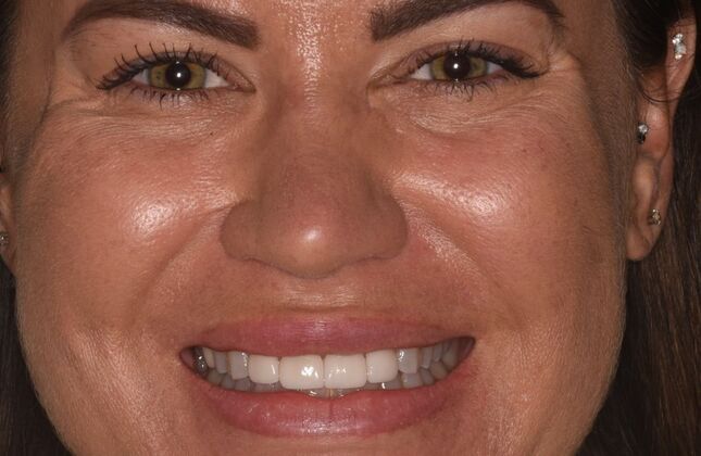 Cosmetic Dentistry Case 10 - After