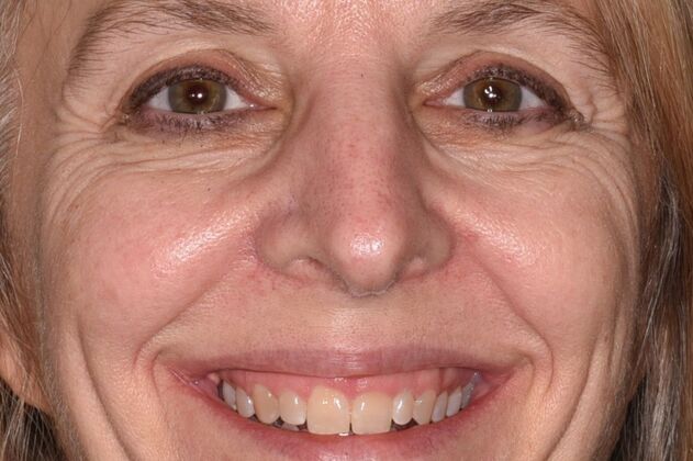 Cosmetic Dentistry Case 11 - Before