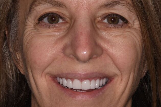 Cosmetic Dentistry Case 11 - After