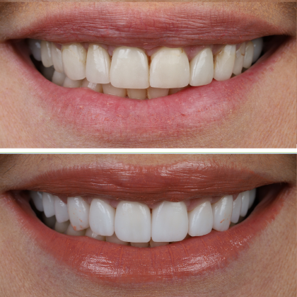 Minimal Prep Porcelain Veneers Jodi - Before