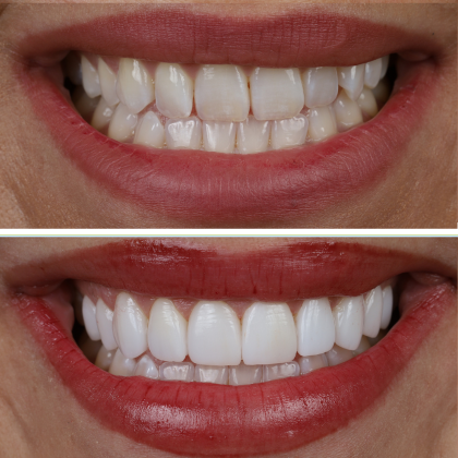 No Prep Porcelain Veneers Briana - Before