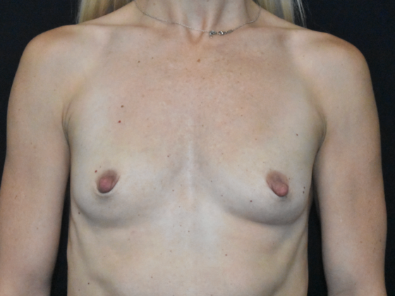 Breast Augmentation Case 30 - Before