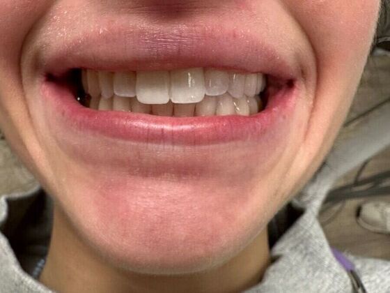 Chipped Tooth Repair: Case 1 - After