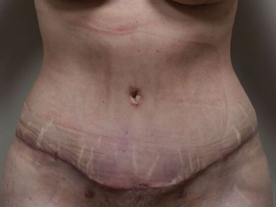 Tummy Tuck (Abdominoplasty): Case 583 - After