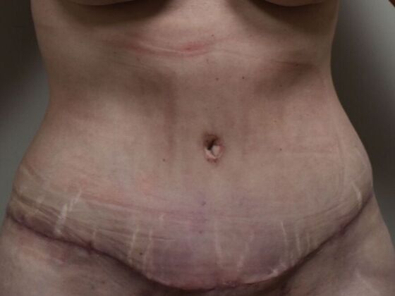 Tummy Tuck (Abdominoplasty): Case 583 - After