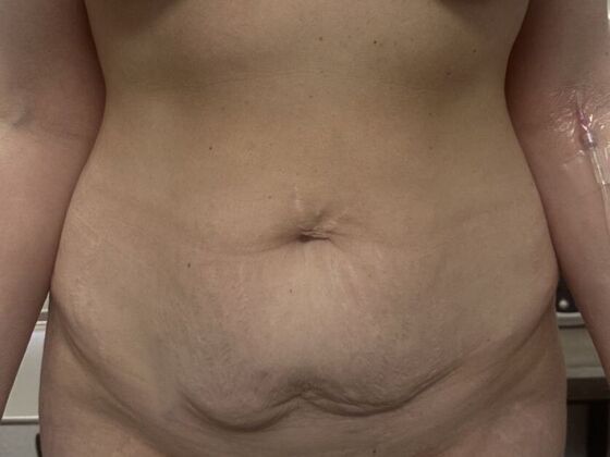 Tummy Tuck (Abdominoplasty): Case 583 - Before